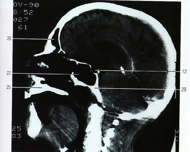 Симптомы при поражениях мозга в черепных ямках