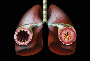 Экстренная терапия синдрома бронхиальной астмы