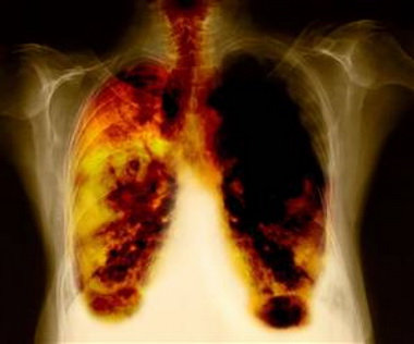 Патогенез периферической формы дыхательной недостаточности сводится к следующим основным положениям