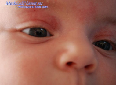 Новорожденные с менингитом, развившимся в первые дни жизни