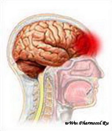 Ушиб головного мозга средней тяжести